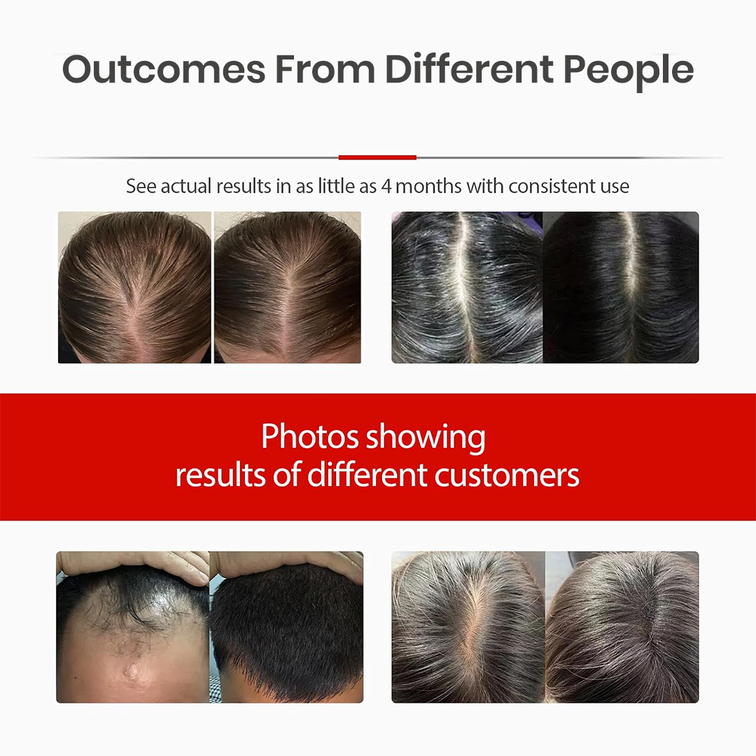 Hair Fall Control & Regrowth LED Therapy Cap