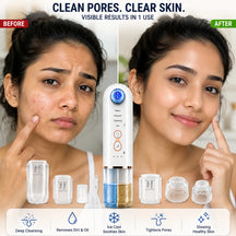 Hydra Facial Blackhead Removal Kit