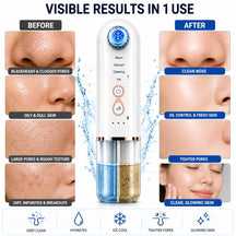 Hydra Facial Blackhead Removal Kit